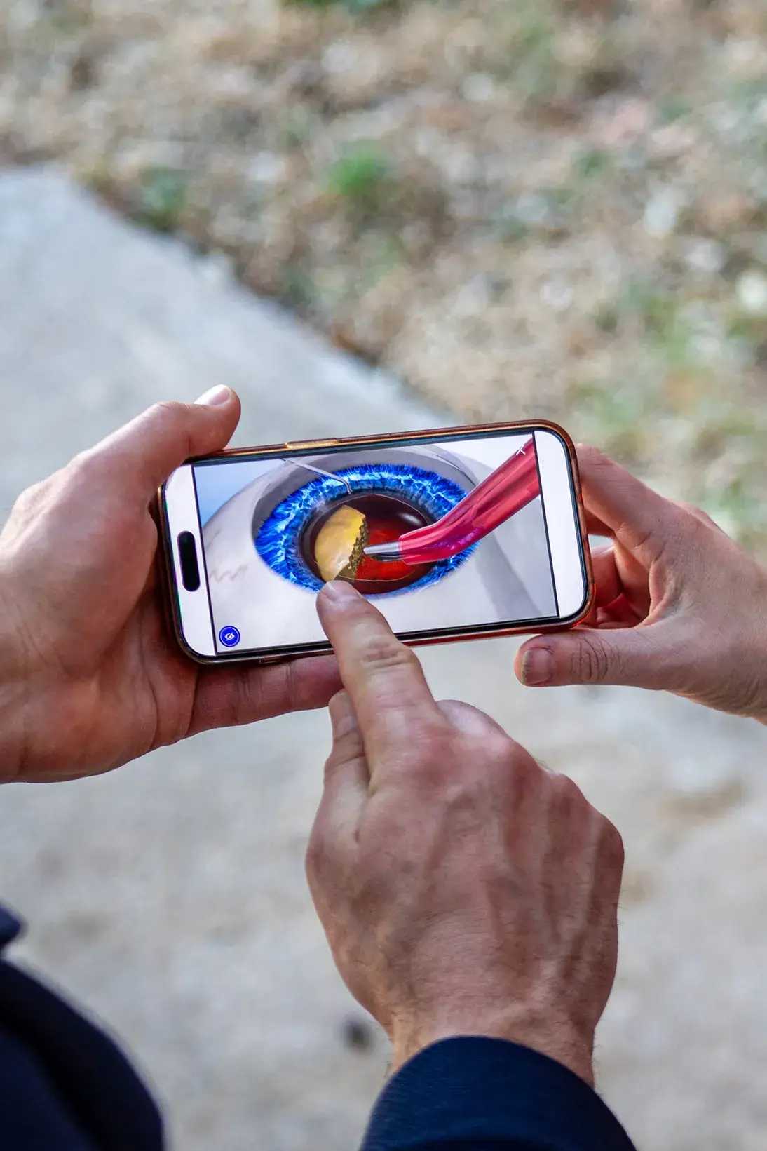 OK Eye Surgeons Surgical Video