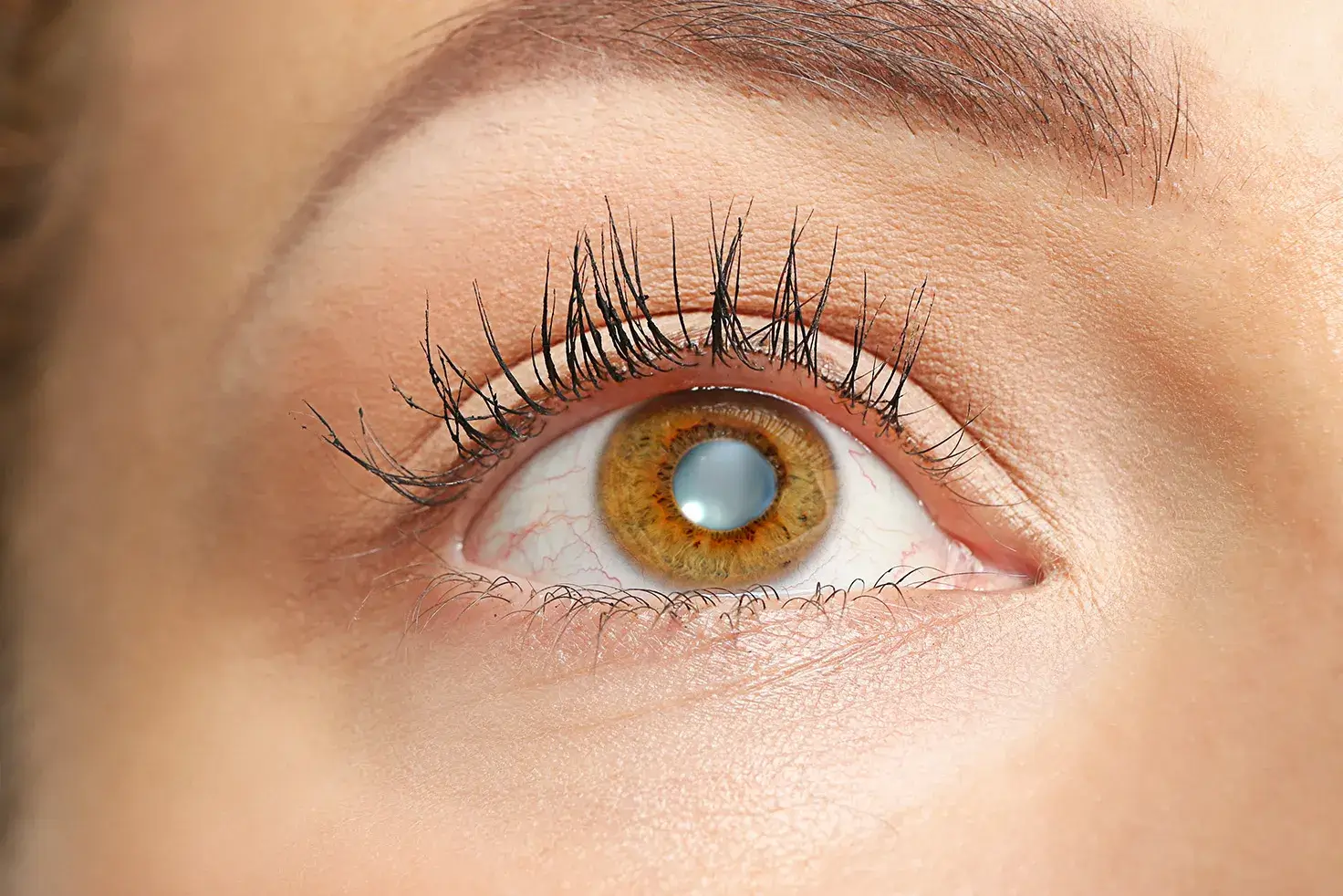Close up of eye with cataract